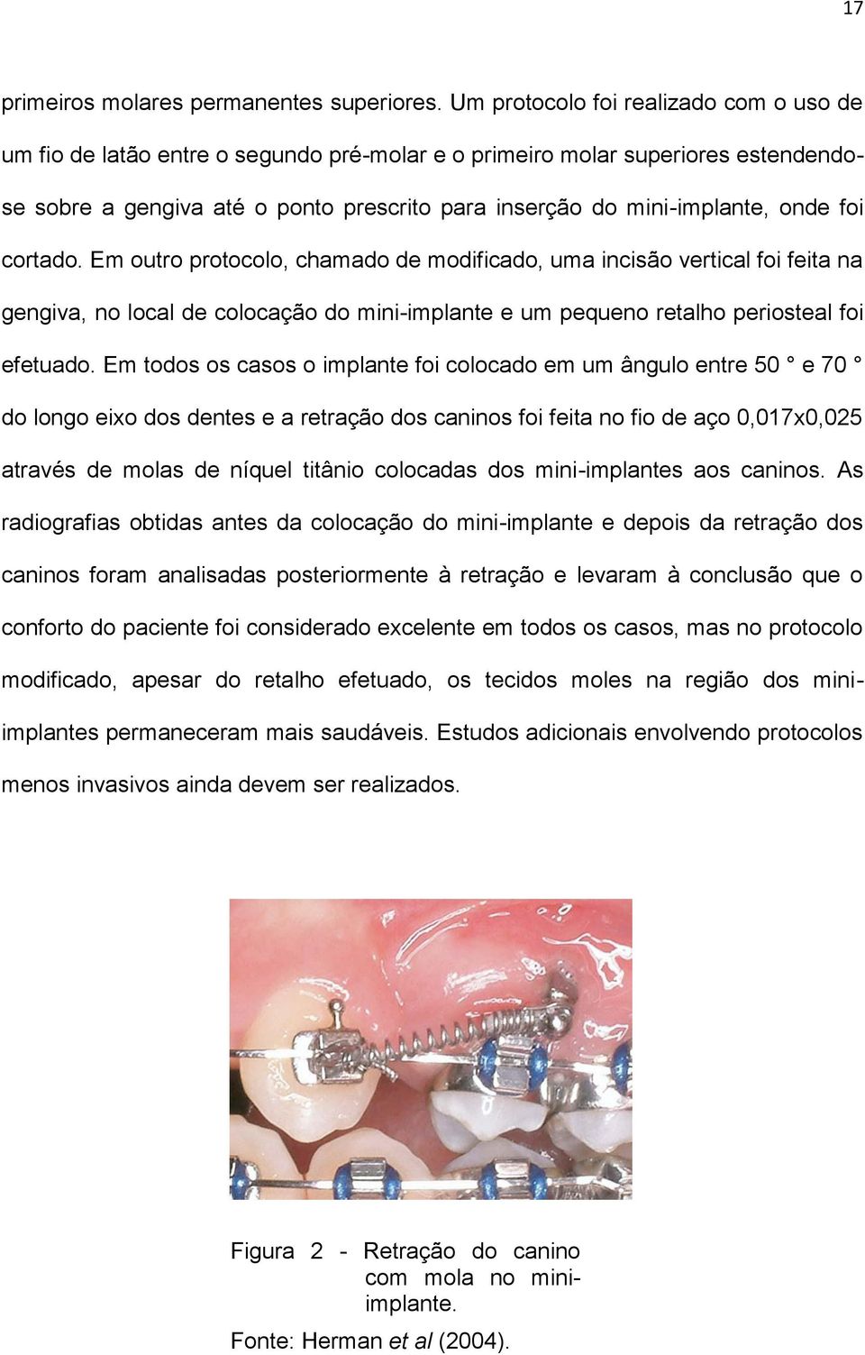 foi cortado. Em outro protocolo, chamado de modificado, uma incisão vertical foi feita na gengiva, no local de colocação do mini-implante e um pequeno retalho periosteal foi efetuado.