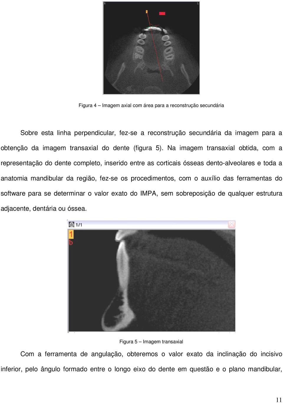 Na imagem transaxial obtida, com a representação do dente completo, inserido entre as corticais ósseas dento-alveolares e toda a anatomia mandibular da região, fez-se os