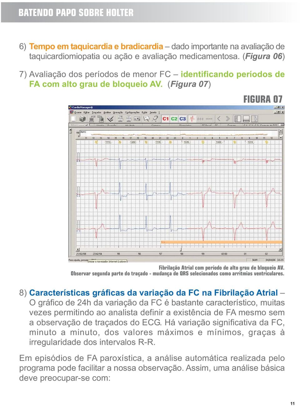 Observar segunda parte do traçado - mudança de QRS selecionados como arritmias ventriculares.