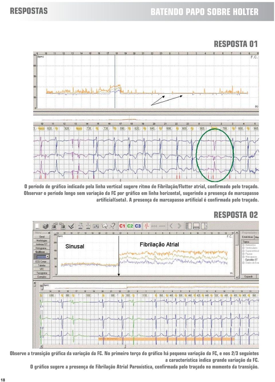 A presença de marcapasso artificial é confirmada pelo traçado. RESPOSTA 02 Observe a transição gráfica da variação da FC.