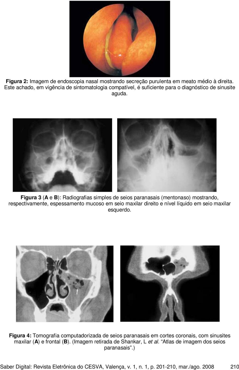 Figura 3 (A e B): Radiografias simples de seios paranasais (mentonaso) mostrando, respectivamente, espessamento mucoso em seio maxilar direito e nível líquido em seio