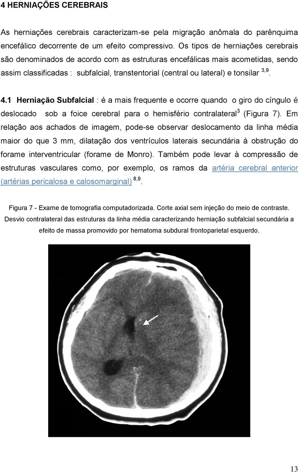 1 Herniação Subfalcial : é a mais frequente e ocorre quando o giro do cíngulo é deslocado sob a foice cerebral para o hemisfério contralateral 3 (Figura 7).