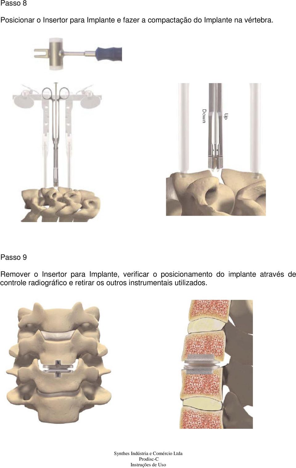 Passo 9 Remover o Insertor para Implante, verificar o