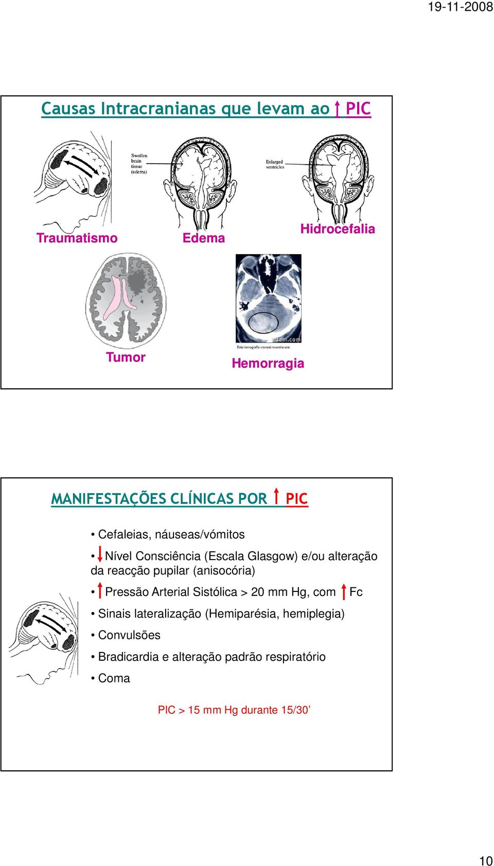 reacção pupilar (anisocória) Pressão Arterial Sistólica > 20 mm Hg, com Fc Sinais lateralização