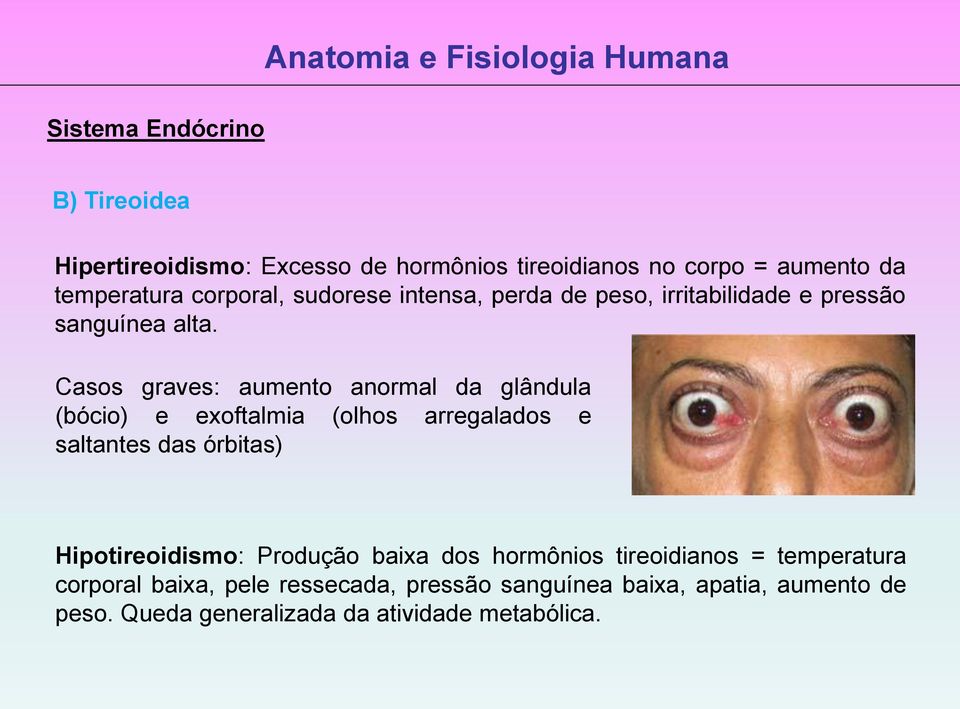 Casos graves: aumento anormal da glândula (bócio) e exoftalmia (olhos arregalados e saltantes das órbitas)