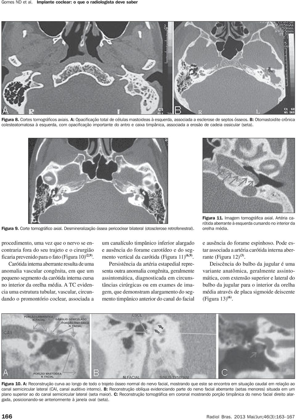 Desmineralização óssea pericoclear bilateral (otosclerose retrofenestral). Figura 11. Imagem tomográfica axial. Artéria carótida aberrante à esquerda cursando no interior da orelha média.