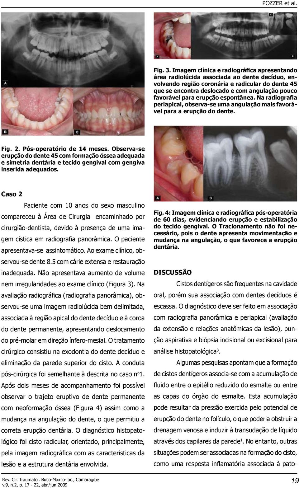 para erupção espontânea. Na radiografia periapical, observa-se uma angulação mais favorável para a erupção do dente. Fig. 2. Pós-operatório de 14 meses.