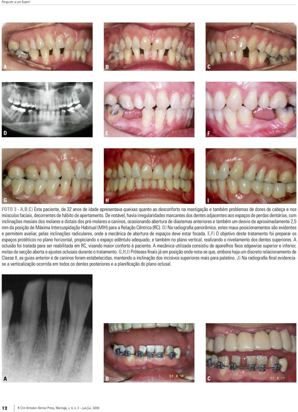 De notável, havia irregularidades marcantes dos dentes adjacentes aos espaços de perdas dentárias, com inclinações mesiais dos molares e distais dos pré-molares e caninos, ocasionando abertura de