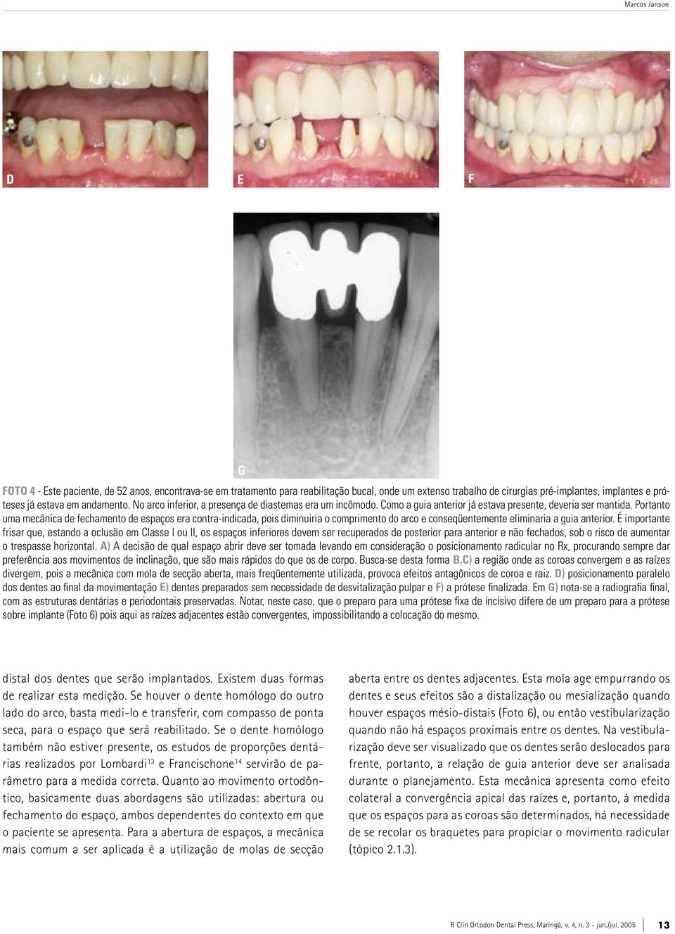 Portanto uma mecânica de fechamento de espaços era contra-indicada, pois diminuiria o comprimento do arco e conseqüentemente eliminaria a guia anterior.