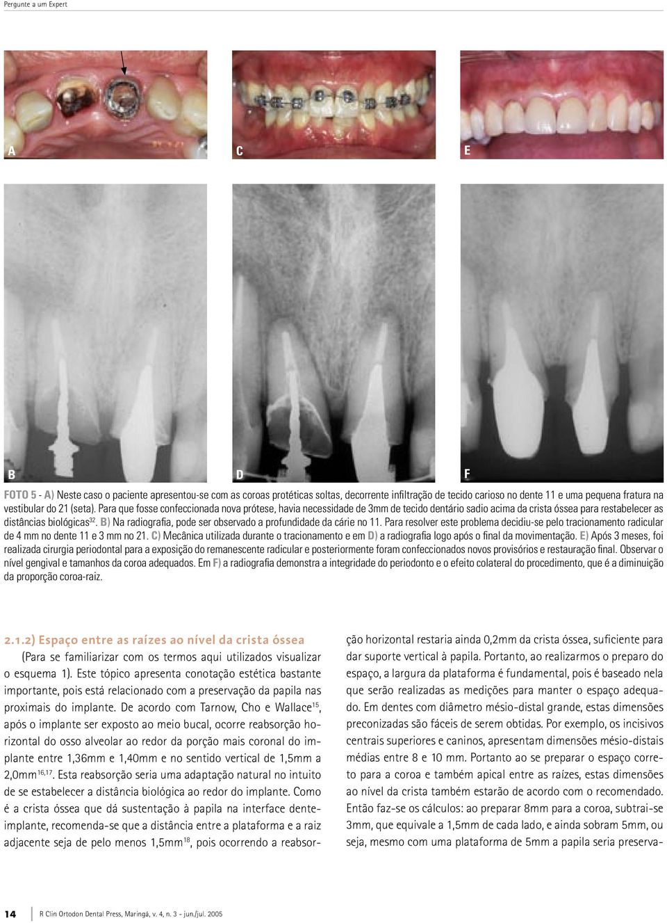 B) Na radiografia, pode ser observado a profundidade da cárie no 11. Para resolver este problema decidiu-se pelo tracionamento radicular de 4 mm no dente 11 e 3 mm no 21.