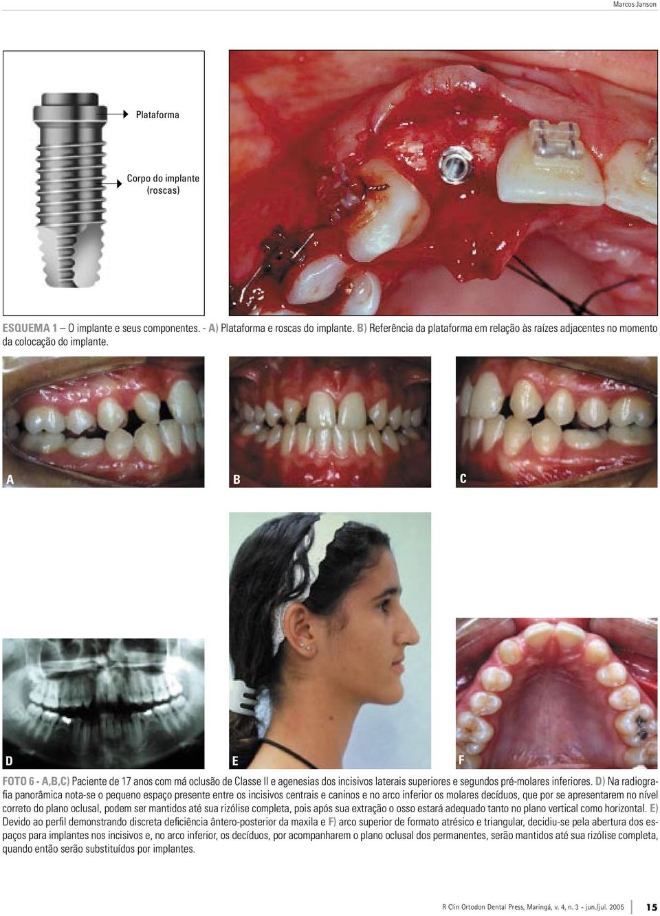 A B C D E F FOTO 6 - A,B,C) Paciente de 17 anos com má oclusão de Classe II e agenesias dos incisivos laterais superiores e segundos pré-molares inferiores.