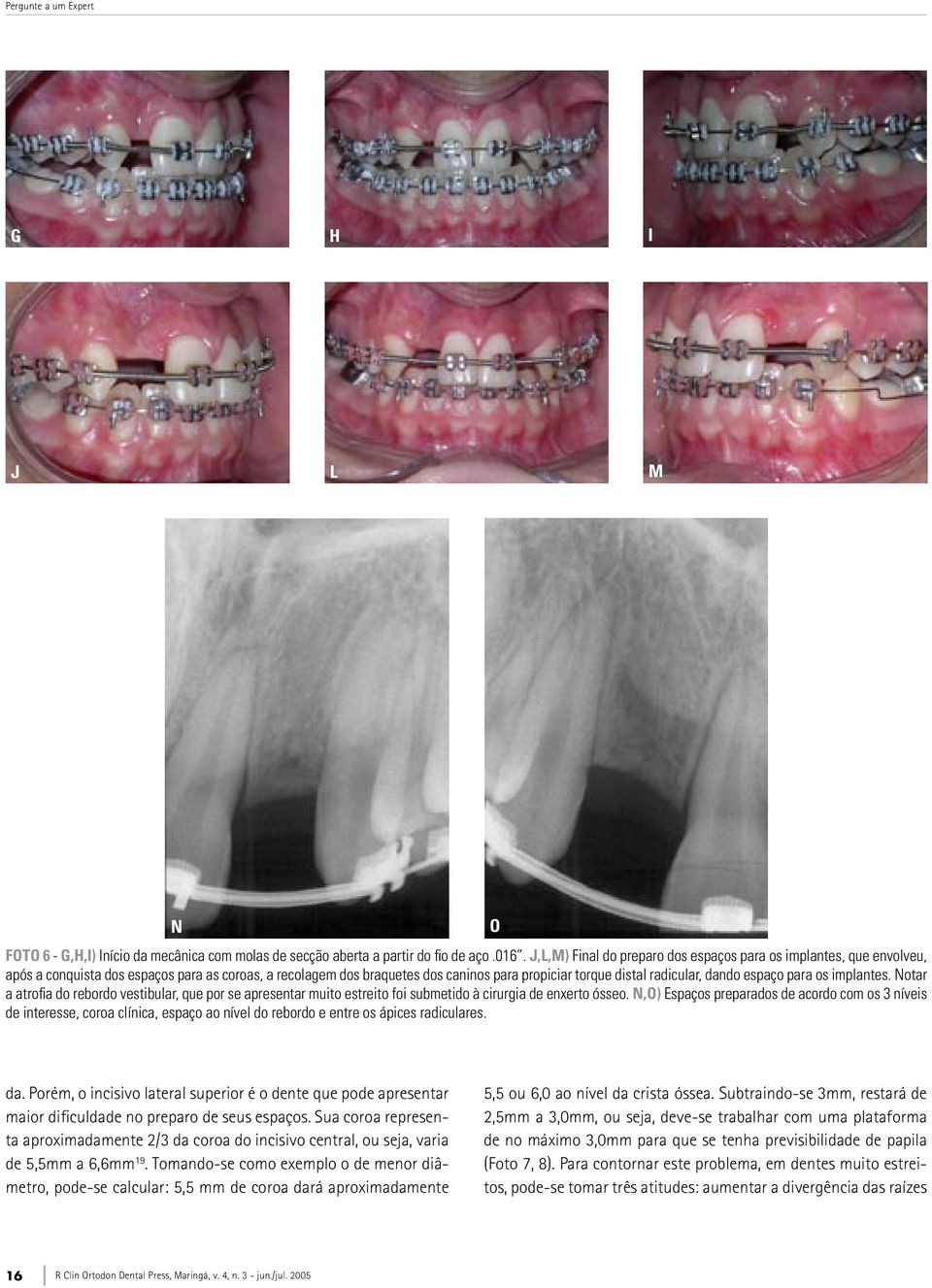 espaço para os implantes. Notar a atrofia do rebordo vestibular, que por se apresentar muito estreito foi submetido à cirurgia de enxerto ósseo.