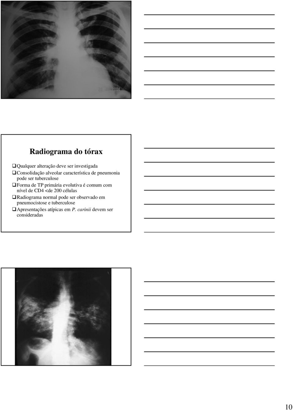 comum com nível de CD4 <de 200 células Radiograma normal pode ser observado em