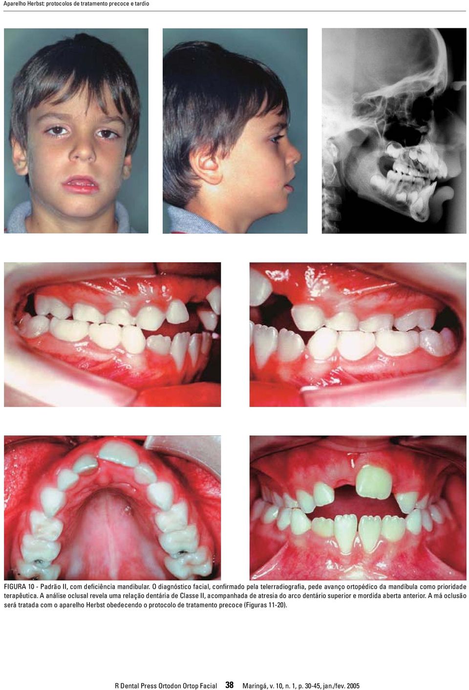 A análise oclusal revela uma relação dentária de Classe II, acompanhada de atresia do arco dentário superior e mordida aberta anterior.