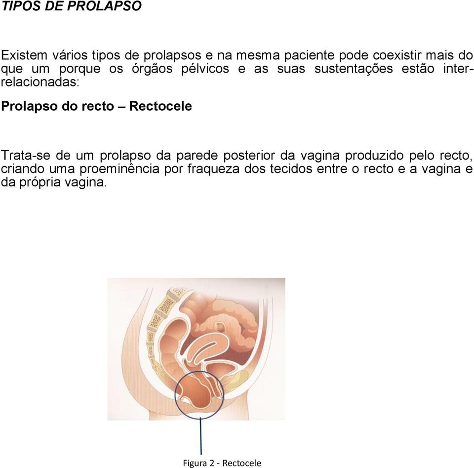 Rectocele Trata-se de um prolapso da parede posterior da vagina produzido pelo recto, criando uma