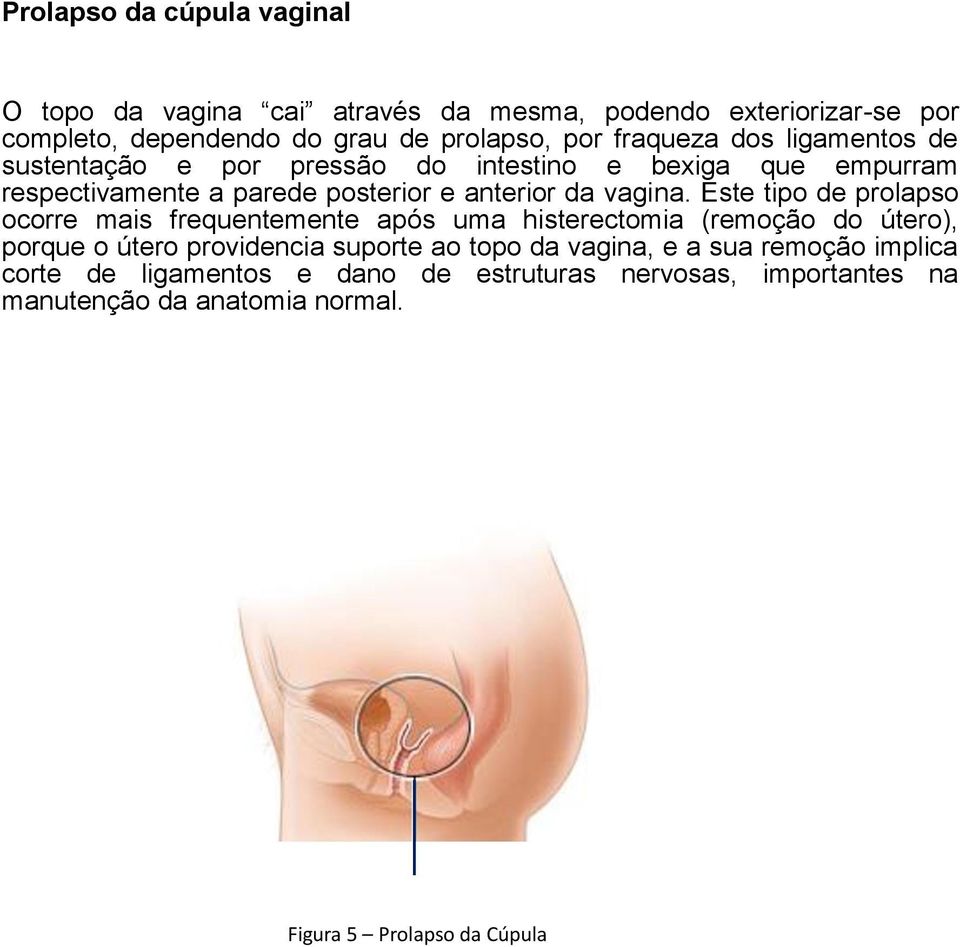 Este tipo de prolapso ocorre mais frequentemente após uma histerectomia (remoção do útero), porque o útero providencia suporte ao topo da