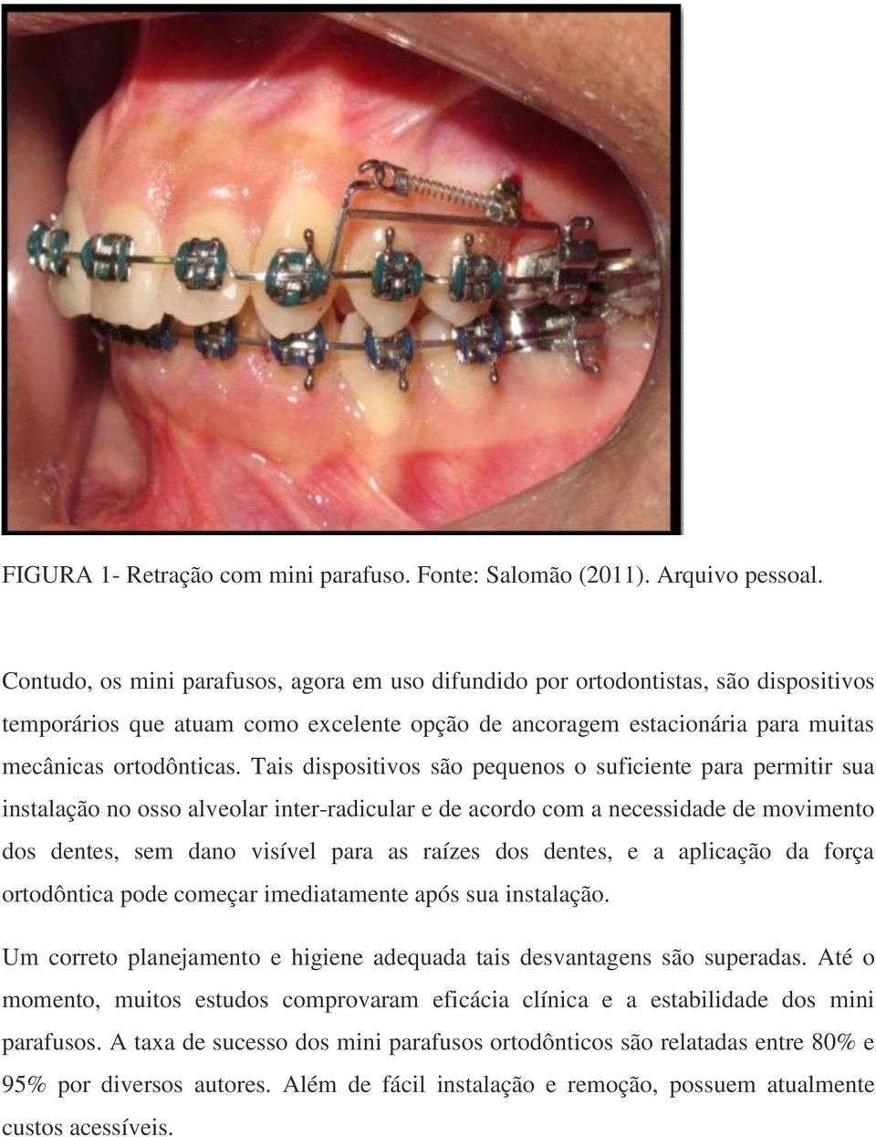 Tais dispositivos são pequenos o suficiente para permitir sua instalação no osso alveolar inter-radicular e de acordo com a necessidade de movimento dos dentes, sem dano visível para as raízes dos