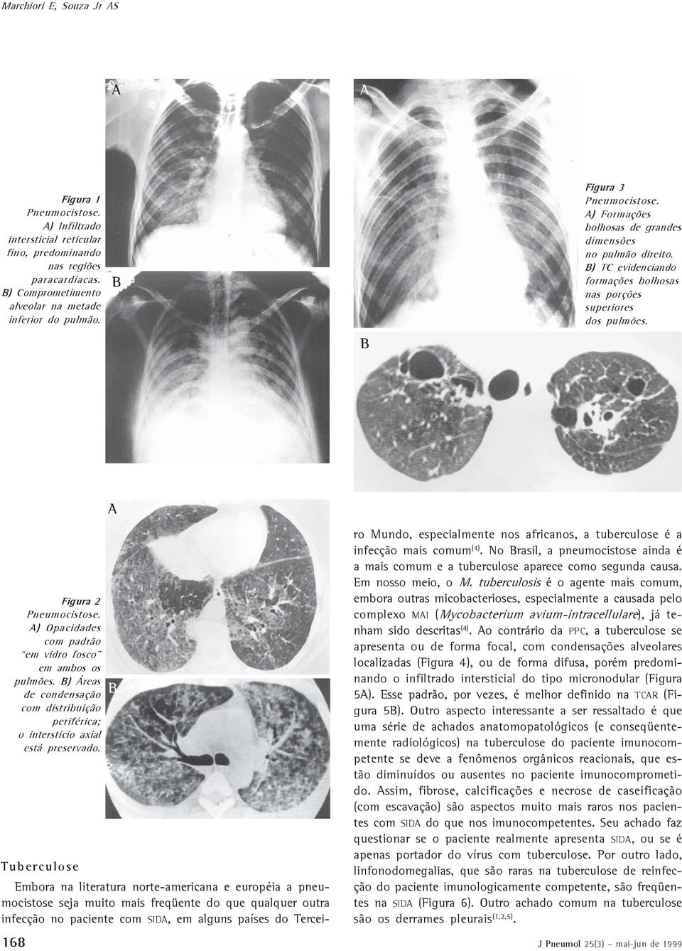 ) Opacidades com padrão em vidro fosco em ambos os pulmões. ) Áreas de condensação com distribuição periférica; o interstício axial está preservado.