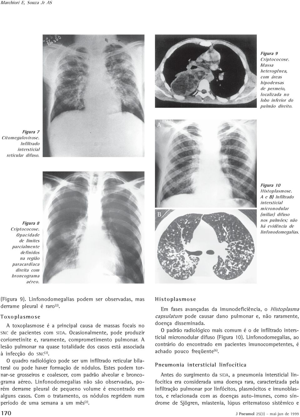 e ) Infiltrado intersticial micronodular (miliar) difuso nos pulmões; não há evidência de linfonodomegalias. (Figura 9). Linfonodomegalias podem ser observadas, mas derrame pleural é raro (2).