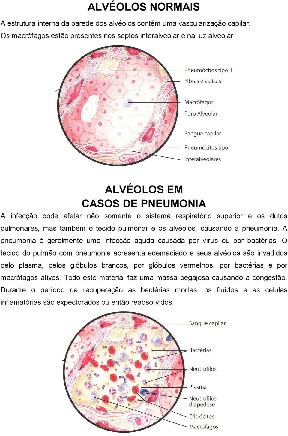 A pneumonia é geralmente uma infecção aguda causada por vírus ou por bactérias, O tecido do pulmão com pneumonia apresenta edemaciado e seus alvéolos são invadidos pelo plasma, pelos glóbulos