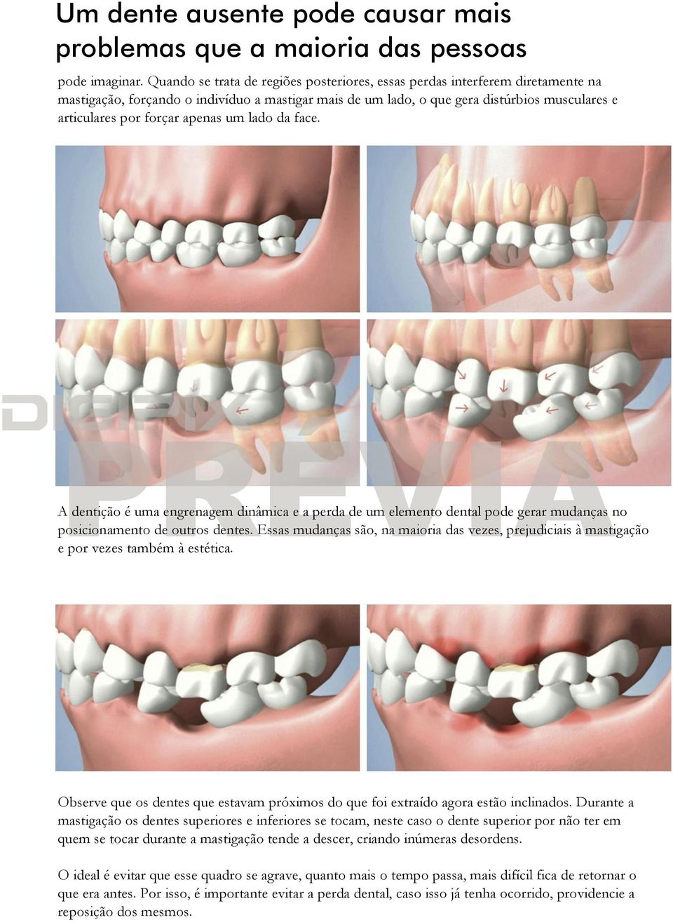 apenas um lado da face. A dentição é uma engrenagem dinâmica e a perda de um elemento dental pode gerar mudanças no posicionamento de outros dentes.