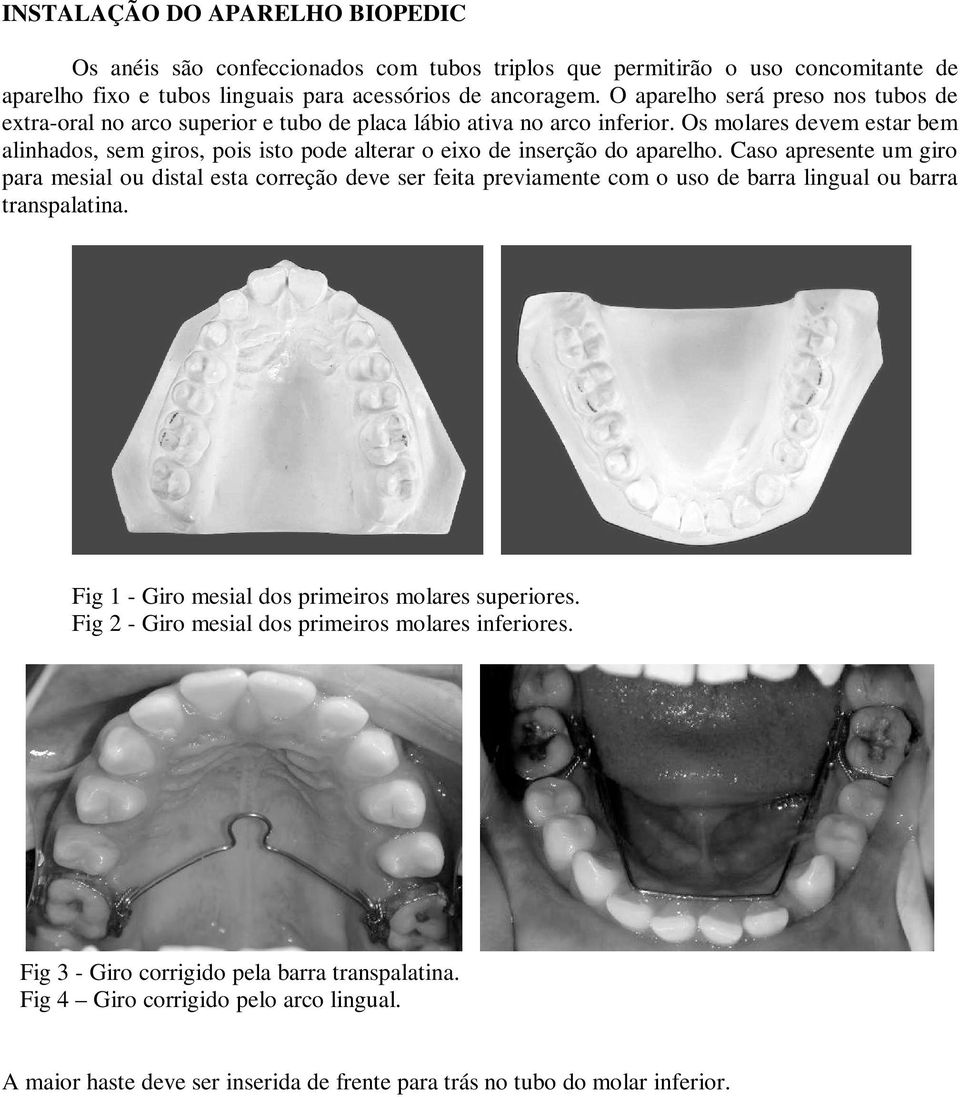 Os molares devem estar bem alinhados, sem giros, pois isto pode alterar o eixo de inserção do aparelho.
