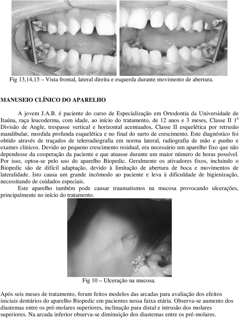 vertical e horizontal acentuados, Classe II esquelética por retrusão mandibular, mordida profunda esquelética e no final do surto de crescimento.