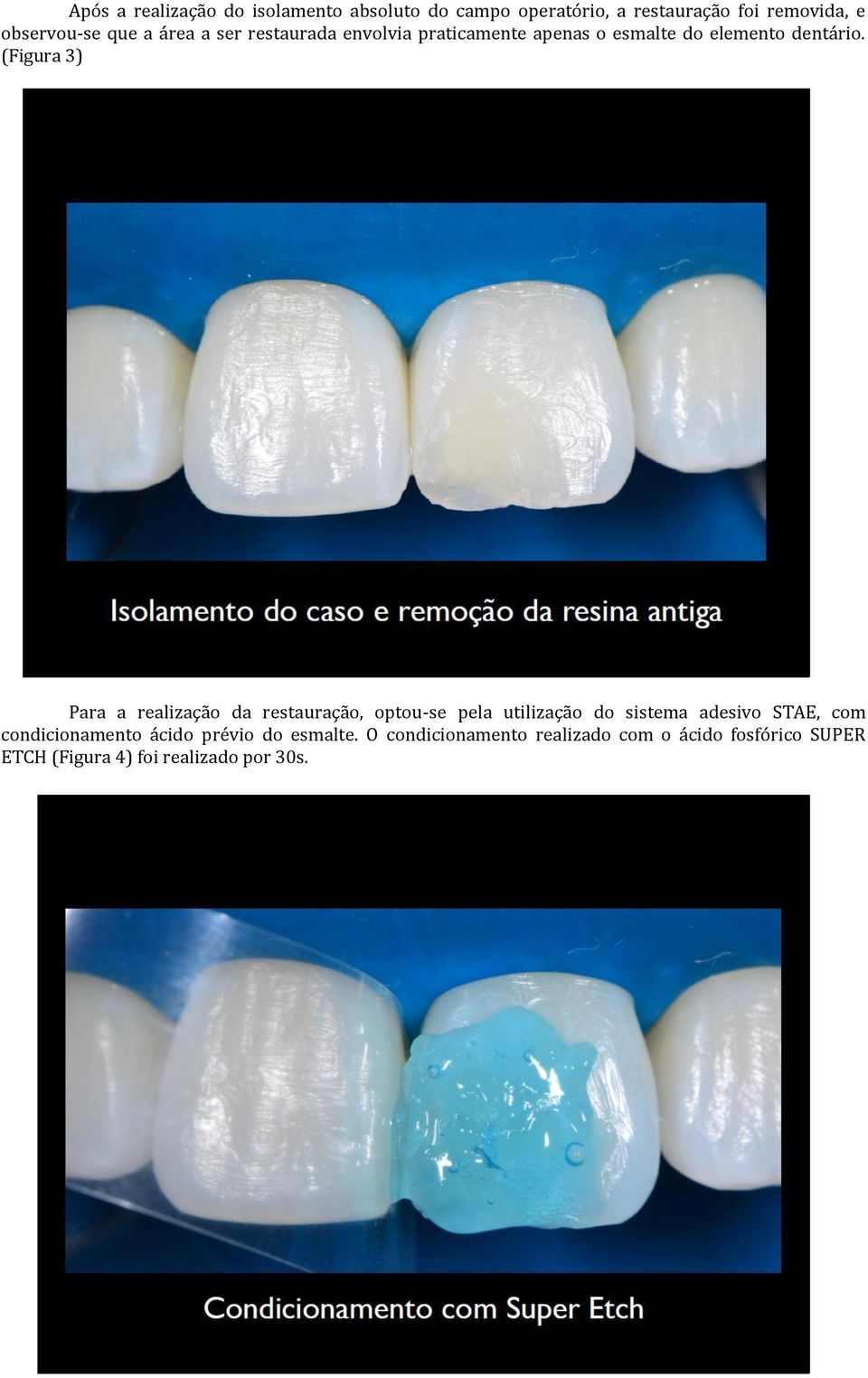 (Figura 3) Para a realização da restauração, optou-se pela utilização do sistema adesivo STAE, com