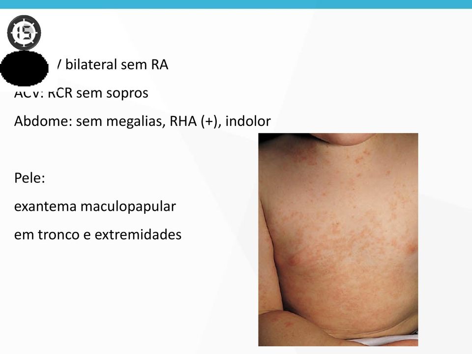 RHA (+), indolor Pele: exantema