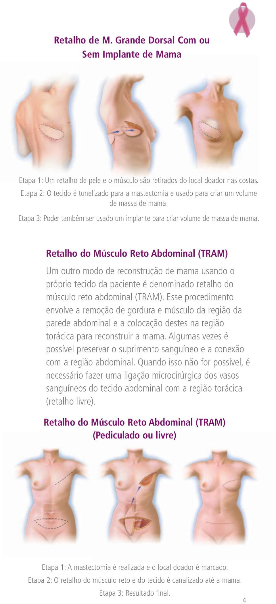 Retalho do Músculo Reto Abdominal (TRAM) Um outro modo de reconstrução de mama usando o próprio tecido da paciente é denominado retalho do músculo reto abdominal (TRAM).