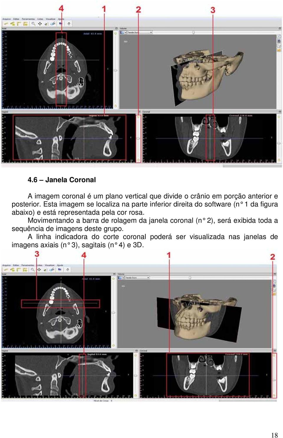 rosa. Movimentando a barra de rolagem da janela coronal (n 2), será exibida toda a sequência de imagens deste