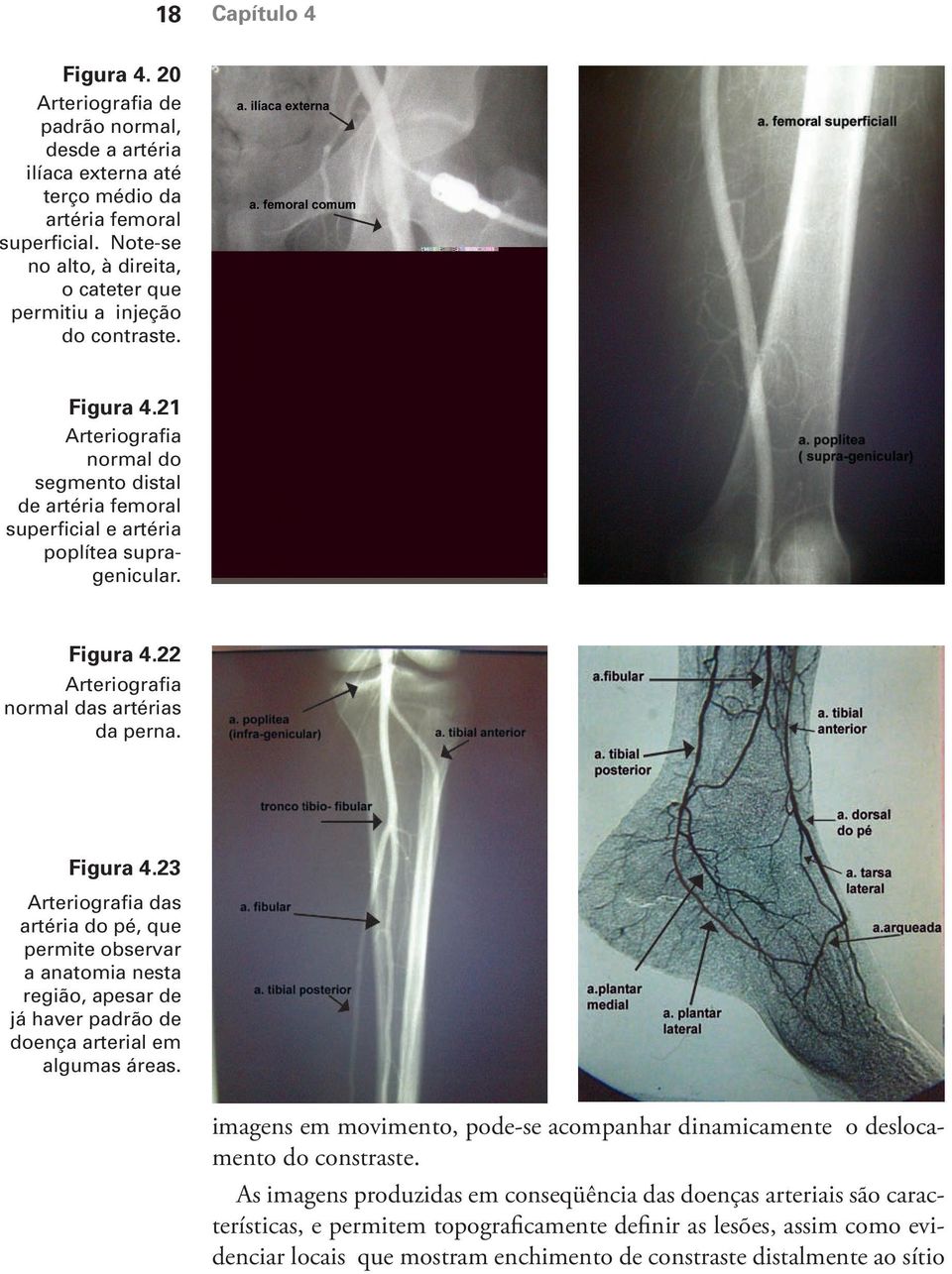 Figura 4.22 Arteriografia normal das artérias da perna. Figura 4.