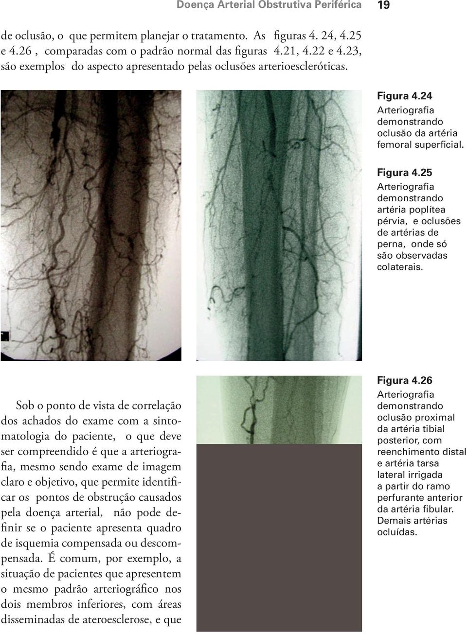 24 Arteriografia demonstrando oclusão da artéria femoral superficial. Figura 4.