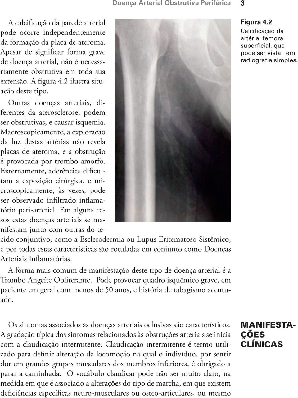 Outras doenças arteriais, diferentes da aterosclerose, podem ser obstrutivas, e causar isquemia.