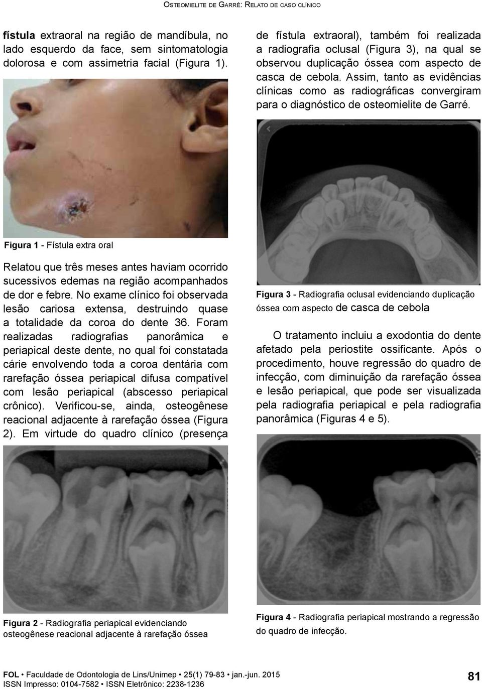 Assim, tanto as evidências clínicas como as radiográficas convergiram para o diagnóstico de osteomielite de Garré.