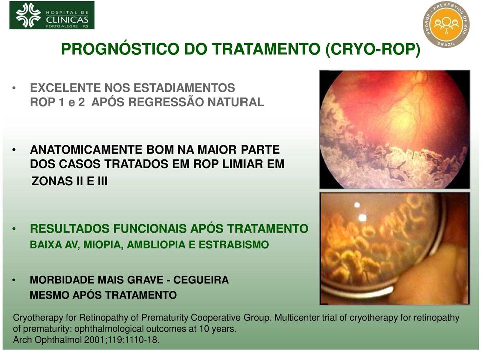 E ESTRABISMO MORBIDADE MAIS GRAVE - CEGUEIRA MESMO APÓS TRATAMENTO Cryotherapy for Retinopathy of Prematurity Cooperative Group.