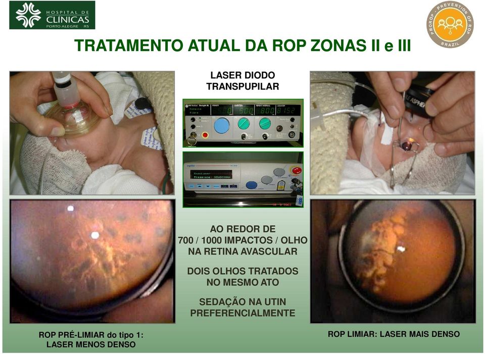 OLHOS TRATADOS NO MESMO ATO SEDAÇÃO NA UTIN PREFERENCIALMENTE ROP