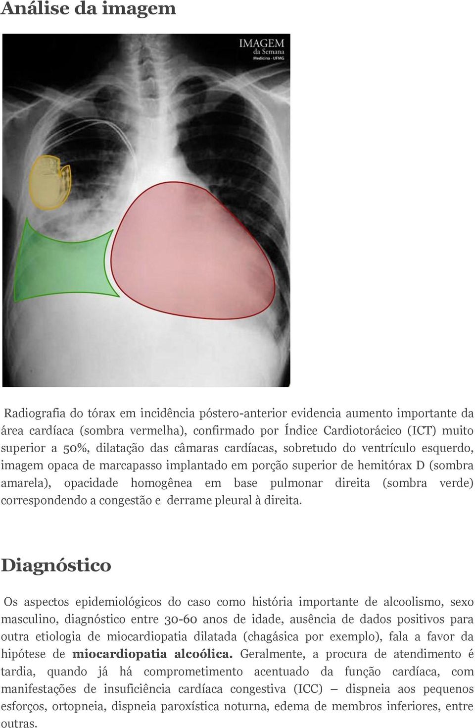 direita (sombra verde) correspondendo a congestão e derrame pleural à direita.