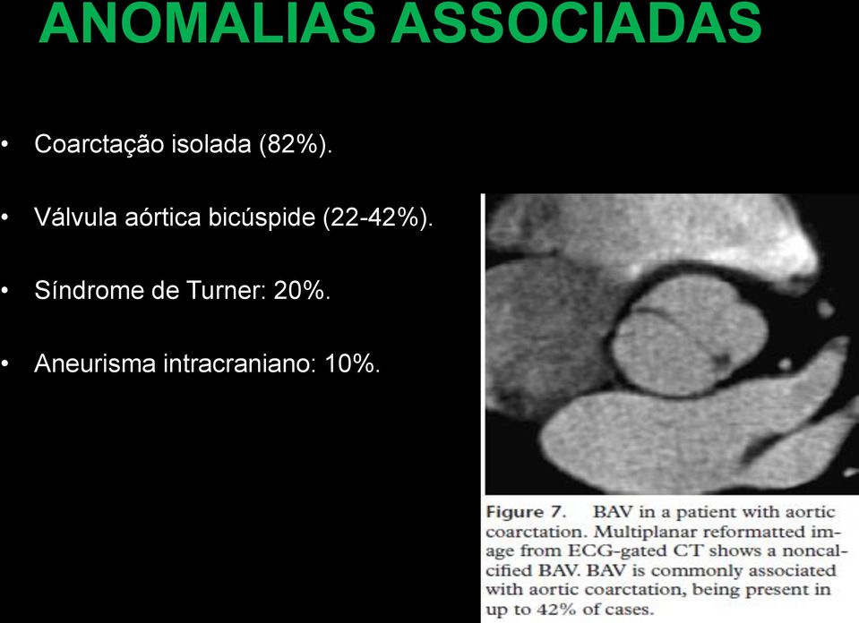 Válvula aórtica bicúspide (22-42%).