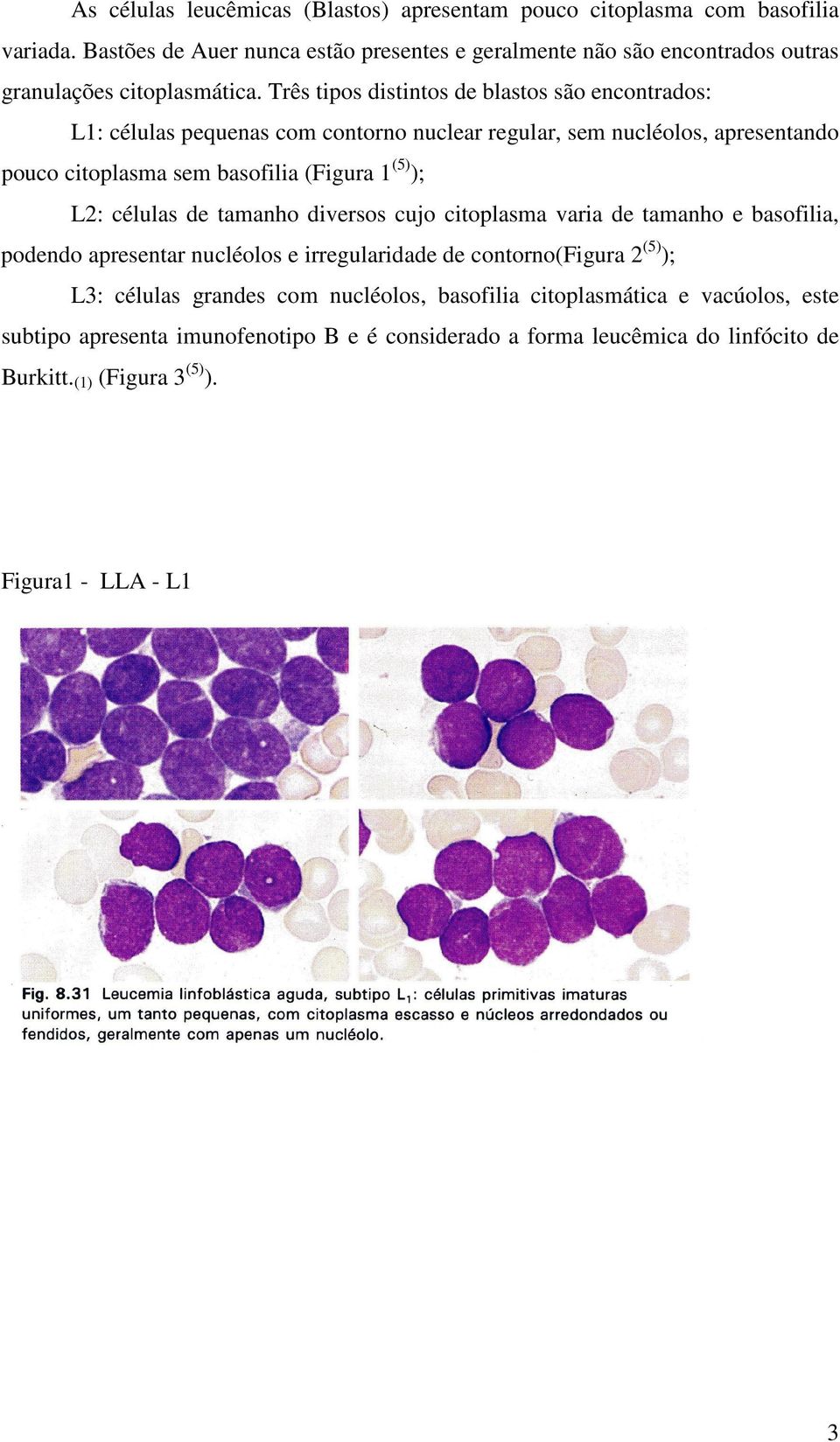 Três tipos distintos de blastos são encontrados: L1: células pequenas com contorno nuclear regular, sem nucléolos, apresentando pouco citoplasma sem basofilia (Figura 1 (5) ); L2: