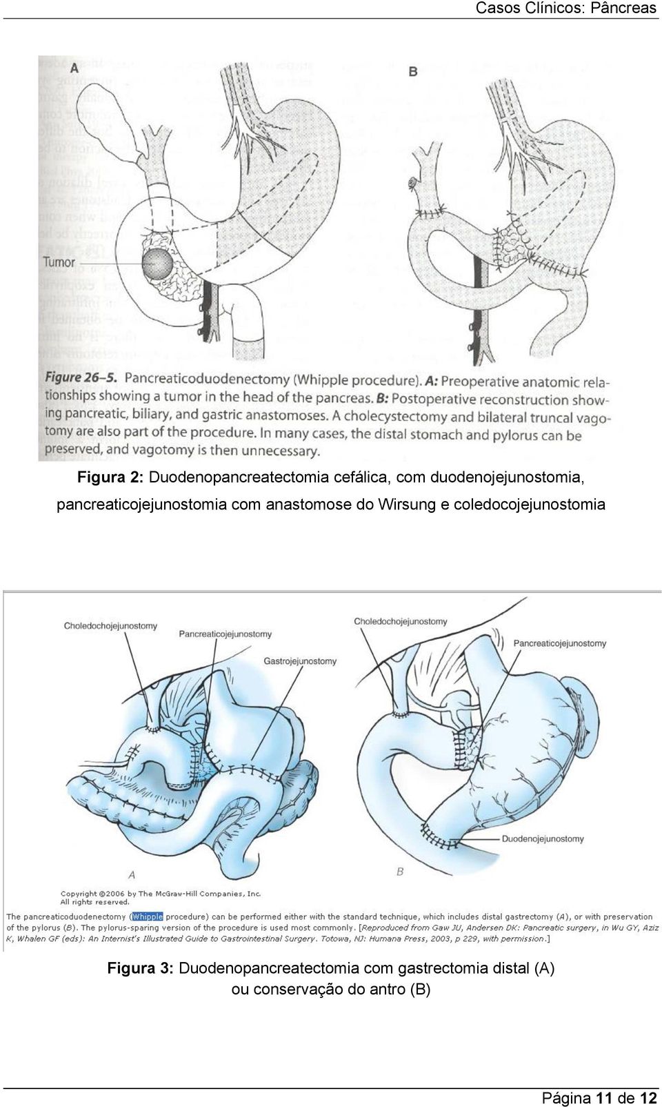 do Wirsung e coledocojejunostomia Figura 3: