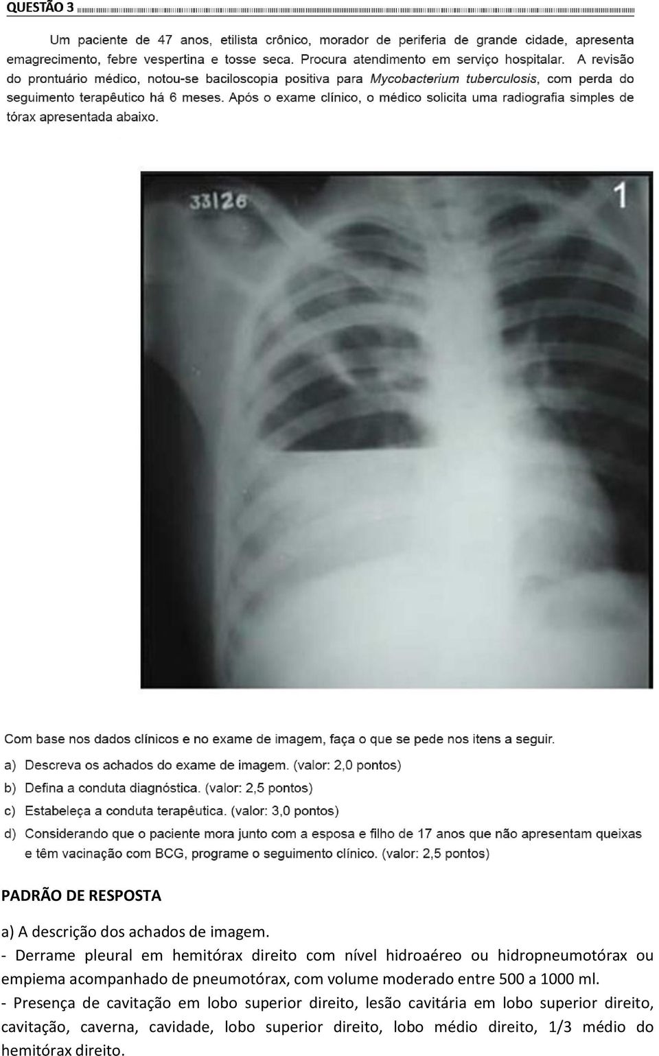 de pneumotórax, com volume moderado entre 500 a 1000 ml.