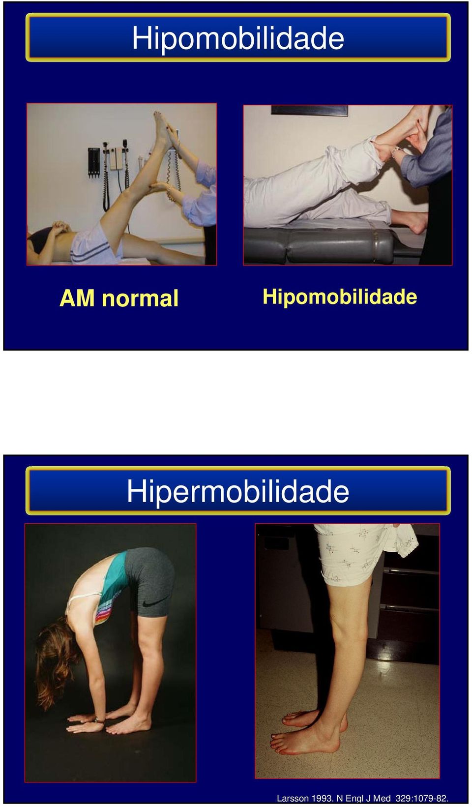 Hipermobilidade Larsson