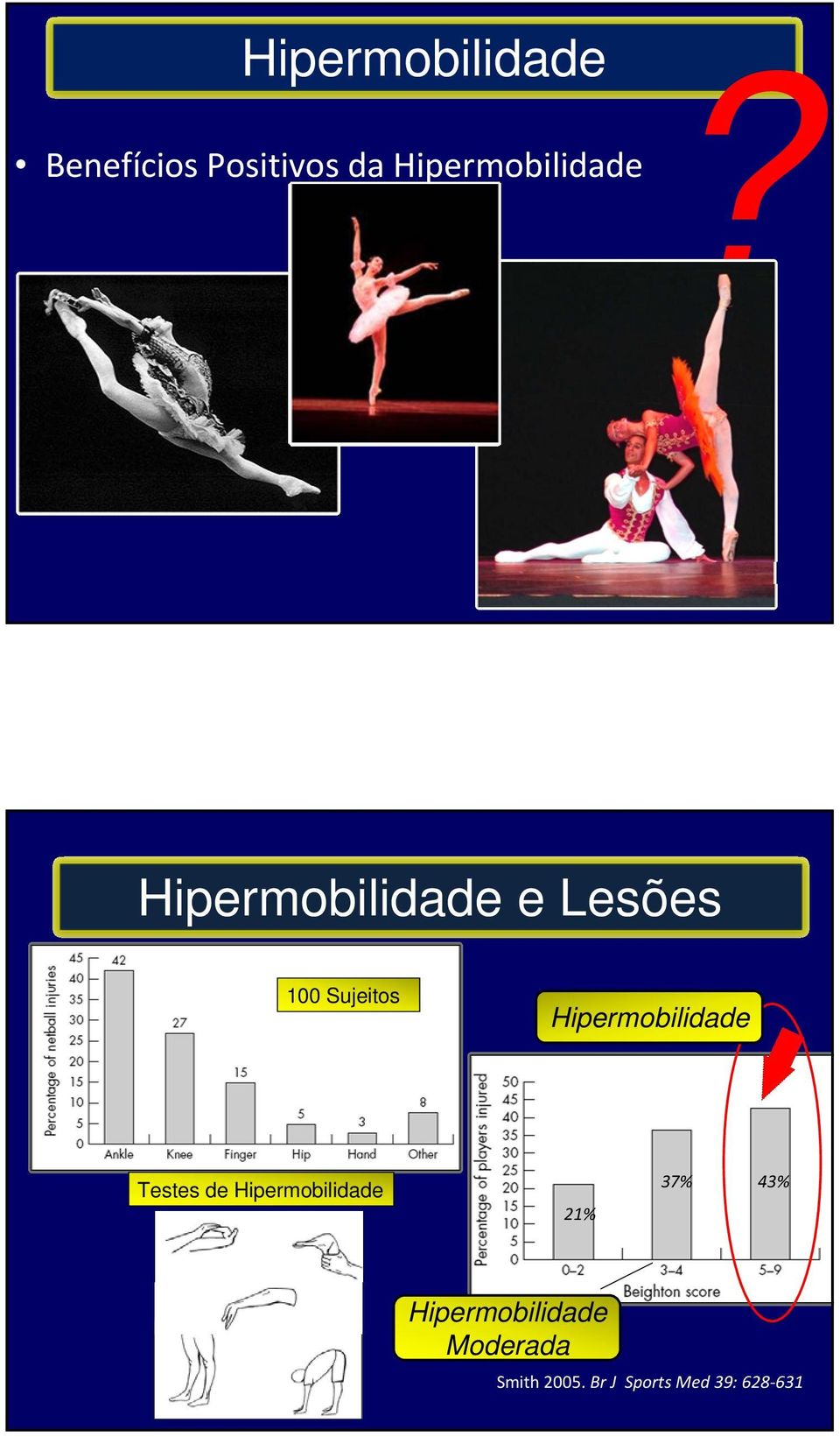 Hipermobilidade e Lesões 100 Sujeitos Hipermobilidade