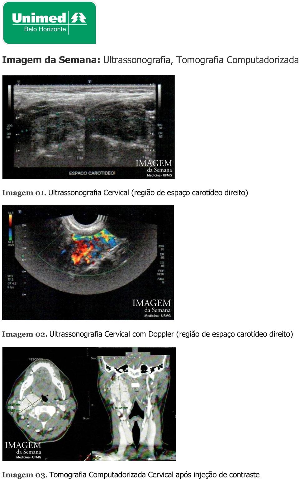 Ultrassonografia Cervical com Doppler (região de espaço carotídeo