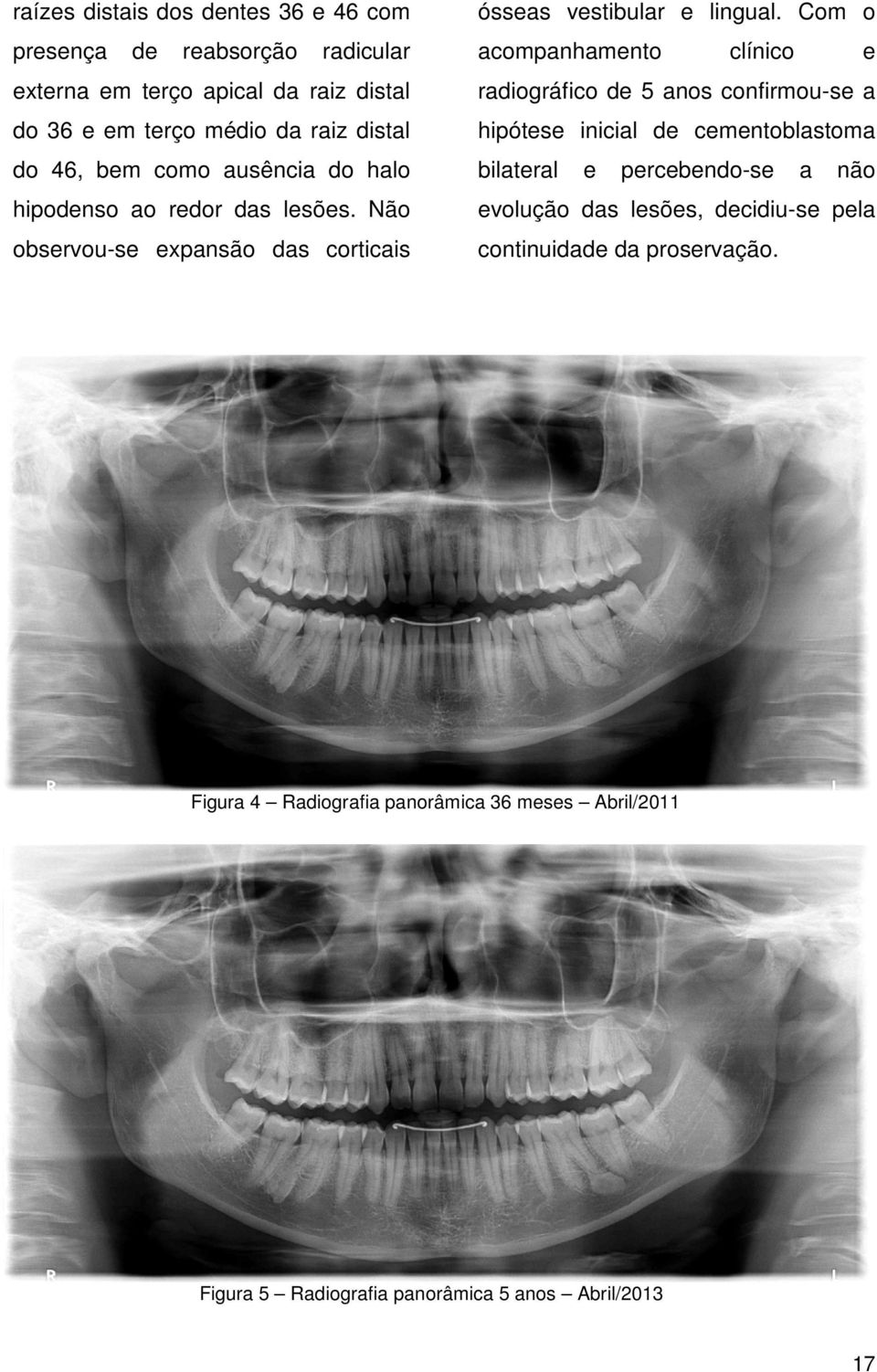 Com o acompanhamento clínico e radiográfico de 5 anos confirmou-se a hipótese inicial de cementoblastoma bilateral e percebendo-se a não evolução