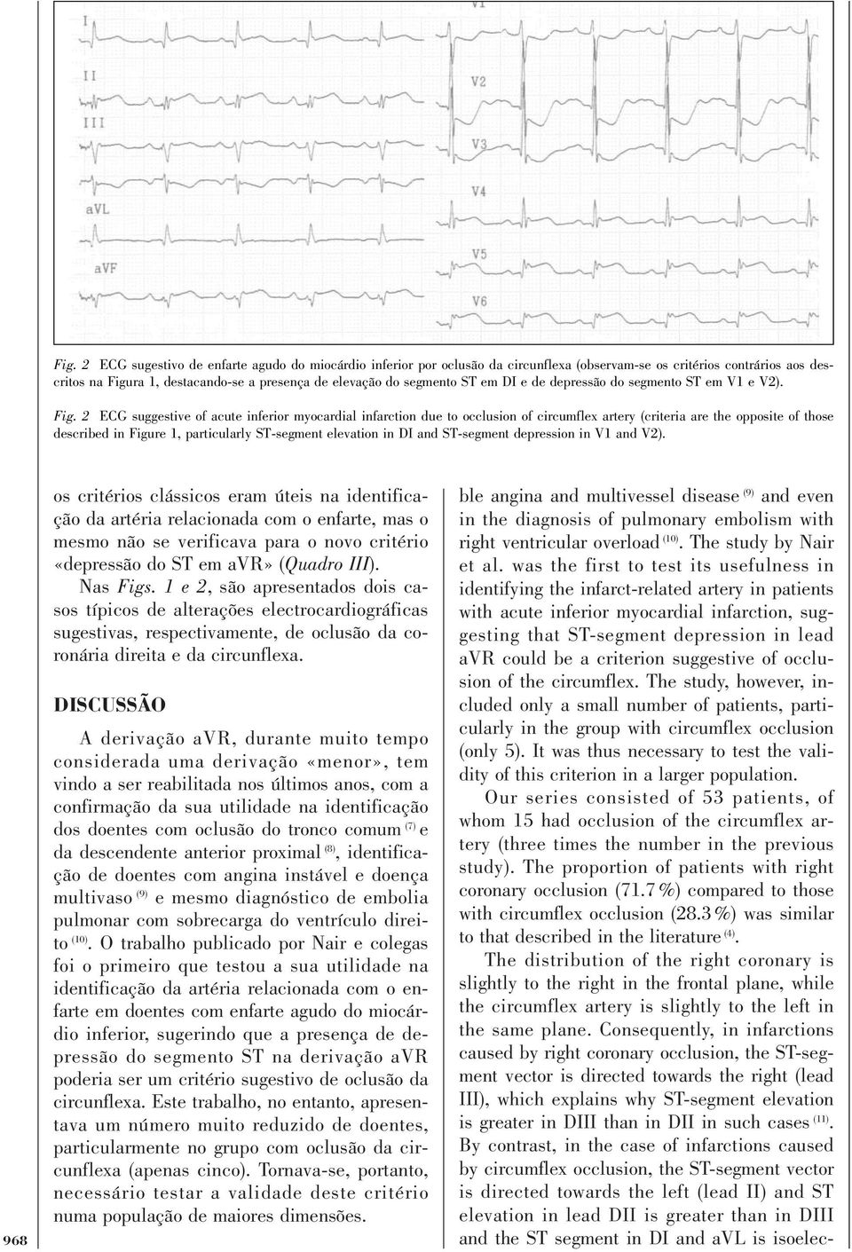 2 ECG suggestive of acute inferior myocardial infarction due to occlusion of circumflex artery (criteria are the opposite of those described in Figure 1, particularly ST-segment elevation in DI and