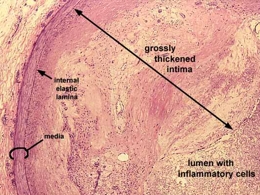 p R T Sistema Circulatório - Histopatologia VE IR -I C BA S