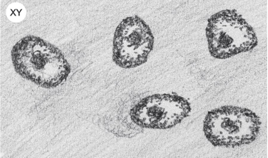 Presença da cromatina sexual Núcleos