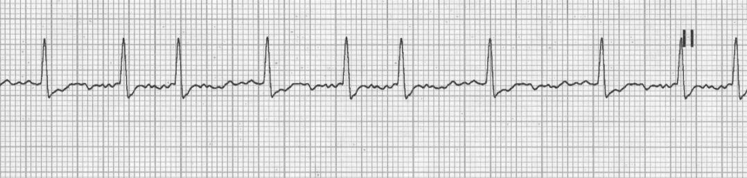 Holter 24h